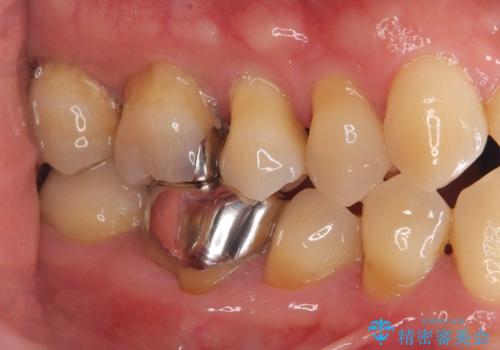 銀歯を白くしたい!|オールセラミッククラウンで審美回復の治療前