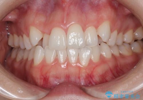【審美装置】非抜歯矯正で八重歯改善!の症例 治療前