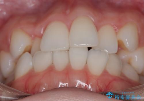 【審美装置】非抜歯矯正で八重歯改善!の治療前