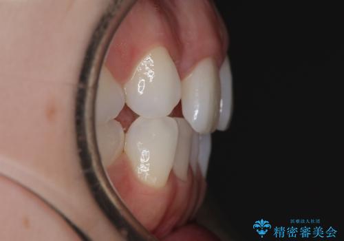 【審美装置】非抜歯矯正で八重歯改善!の治療前