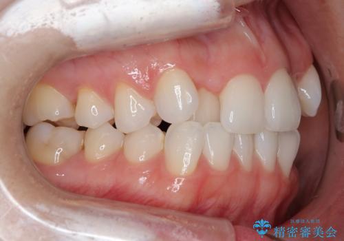 【審美装置】非抜歯矯正で八重歯改善!の治療前