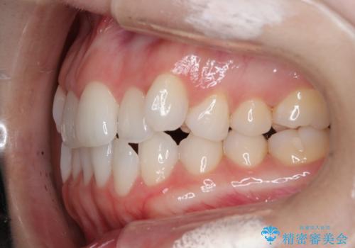 【審美装置】非抜歯矯正で八重歯改善!の治療前