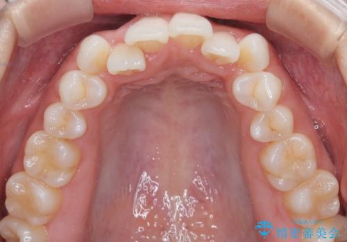 【審美装置】非抜歯矯正で八重歯改善!の治療前