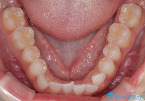 【審美装置】非抜歯矯正で八重歯改善!の治療前