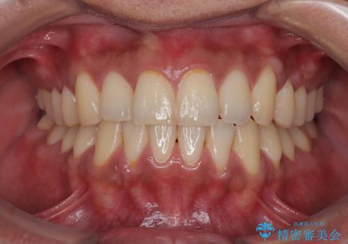 矯正後の後戻りをインビザラインライトで再治療|目立たない矯正の症例紹介の症例 治療後