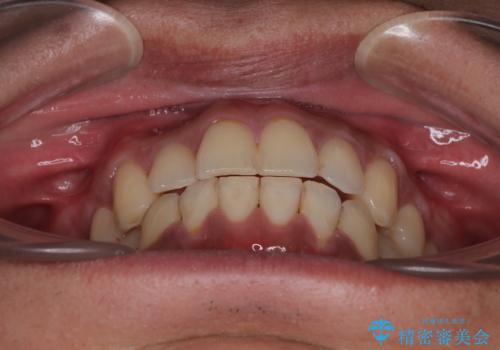 矯正後の後戻りをインビザラインライトで再治療|目立たない矯正の症例紹介の治療後