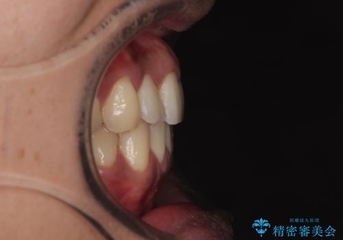 矯正後の後戻りをインビザラインライトで再治療|目立たない矯正の症例紹介の治療後