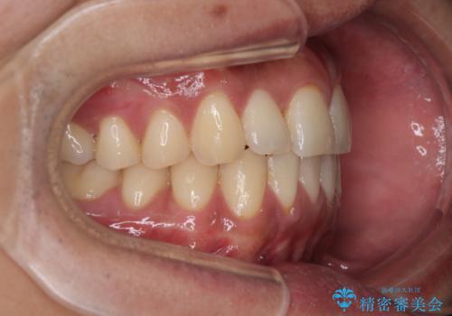 矯正後の後戻りをインビザラインライトで再治療|目立たない矯正の症例紹介の治療後