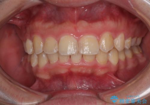 左右に顎がずれた咬み合わせ ワイヤー矯正で咬み合わせを改善の治療後