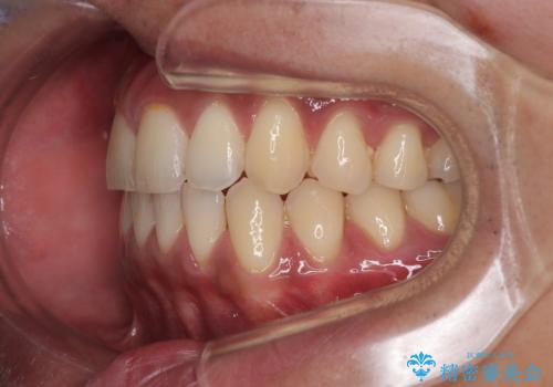 矯正後の後戻りをインビザラインライトで再治療|目立たない矯正の症例紹介の治療後