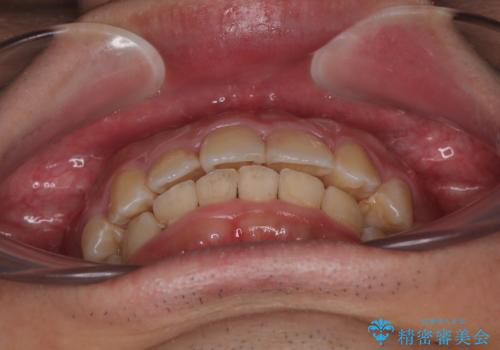 左右に顎がずれた咬み合わせ ワイヤー矯正で咬み合わせを改善の治療後