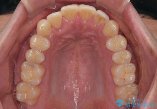 矯正後の後戻りをインビザラインライトで再治療|目立たない矯正の症例紹介の治療後