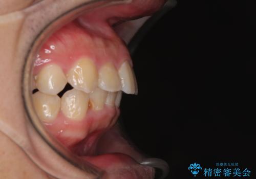 左右に顎がずれた咬み合わせ ワイヤー矯正で咬み合わせを改善の治療後