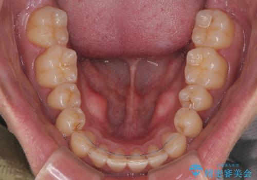 矯正後の後戻りをインビザラインライトで再治療|目立たない矯正の症例紹介の治療後