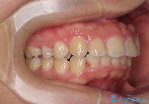 左右に顎がずれた咬み合わせ　ワイヤー矯正で咬み合わせを改善の治療後