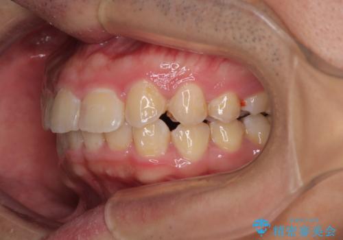 左右に顎がずれた咬み合わせ ワイヤー矯正で咬み合わせを改善の治療後