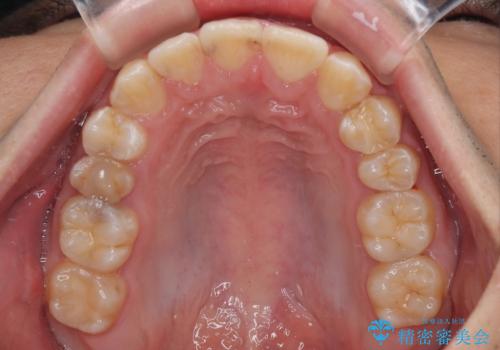 左右に顎がずれた咬み合わせ ワイヤー矯正で咬み合わせを改善の治療後