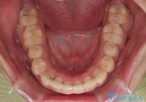 左右に顎がずれた咬み合わせ　ワイヤー矯正で咬み合わせを改善の治療後