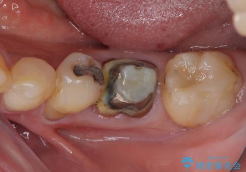 割れてしまった奥歯 1DAYインプラント治療