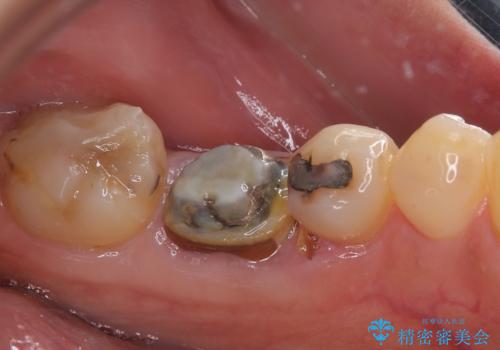 割れてしまった奥歯 1DAYインプラント治療の治療前