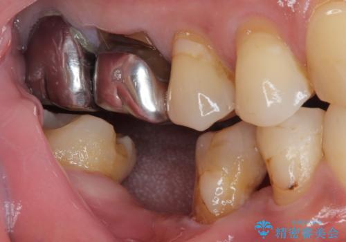 抜歯とむし歯治療を途中で放置　インプラント補綴治療の治療前