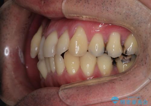 【メタル装置】1本のみ抜歯してワイヤー矯正の治療前