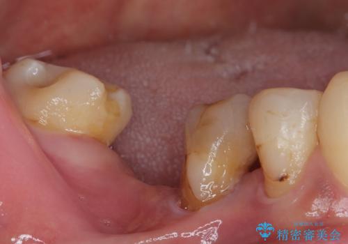 抜歯とむし歯治療を途中で放置 インプラント補綴治療の治療前