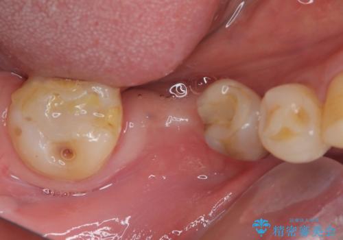 抜歯とむし歯治療を途中で放置 インプラント補綴治療の症例 治療前