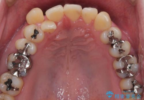 【メタル装置】1本のみ抜歯してワイヤー矯正の治療前
