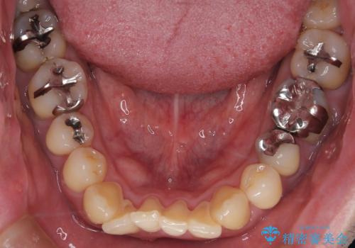 【メタル装置】1本のみ抜歯してワイヤー矯正の治療前