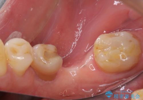 抜歯とむし歯治療を途中で放置　インプラント補綴治療の治療前