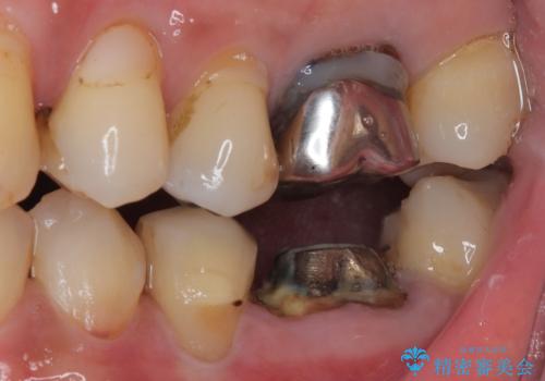 割れてしまった奥歯 1DAYインプラント治療の治療前