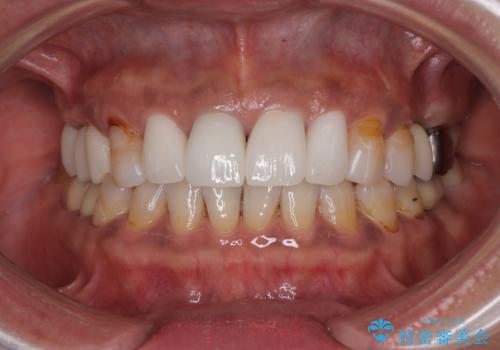 しみる前歯のセラミック治療 周辺も同時に治療して調和の取れた前歯にの治療後