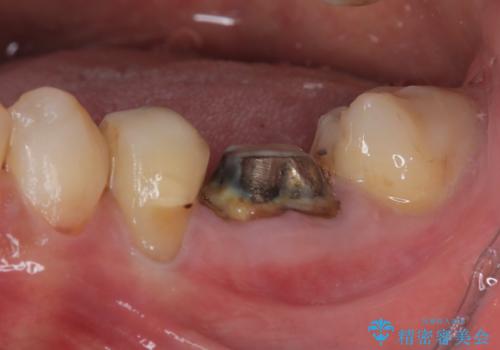 割れてしまった奥歯　1DAYインプラント治療の治療前