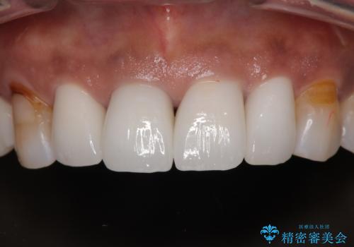 しみる前歯のセラミック治療 周辺も同時に治療して調和の取れた前歯にの治療後