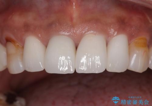 しみる前歯のセラミック治療 周辺も同時に治療して調和の取れた前歯にの治療後