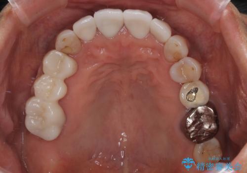 しみる前歯のセラミック治療　周辺も同時に治療して調和の取れた前歯にの治療後