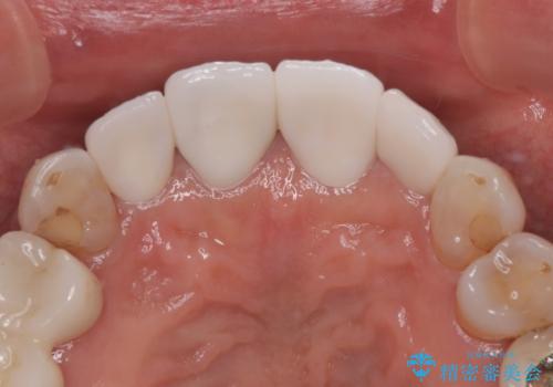 しみる前歯のセラミック治療 周辺も同時に治療して調和の取れた前歯にの治療後