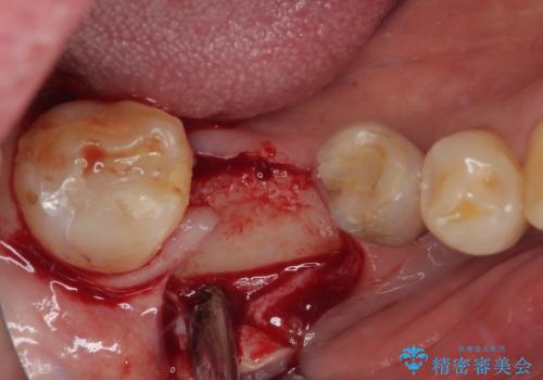 抜歯とむし歯治療を途中で放置 インプラント補綴治療の治療前