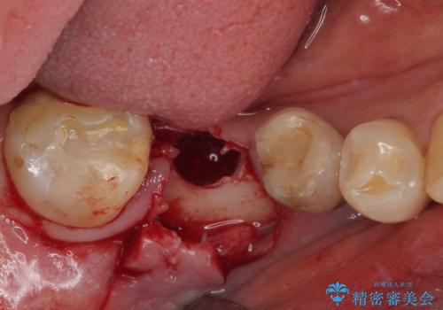 抜歯とむし歯治療を途中で放置 インプラント補綴治療の治療中