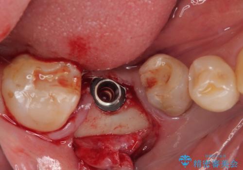 抜歯とむし歯治療を途中で放置 インプラント補綴治療の治療後