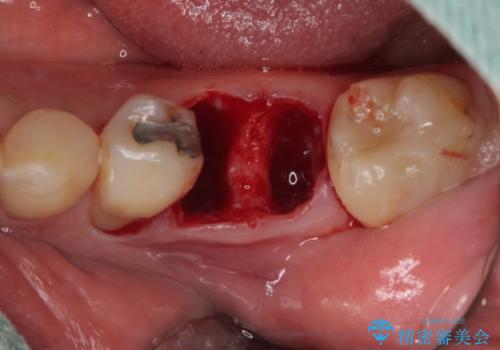 割れてしまった奥歯　1DAYインプラント治療の治療中