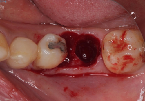 割れてしまった奥歯 1DAYインプラント治療の治療後