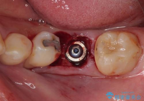 割れてしまった奥歯　1DAYインプラント治療の治療前