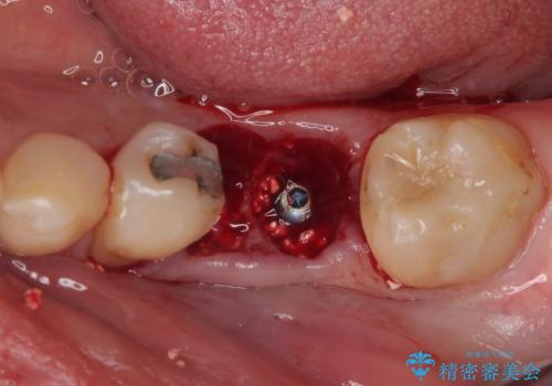 割れてしまった奥歯　1DAYインプラント治療の治療中