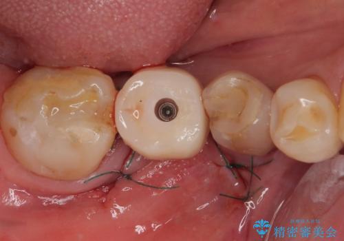 抜歯とむし歯治療を途中で放置 インプラント補綴治療の治療中