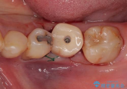 割れてしまった奥歯 1DAYインプラント治療の治療中