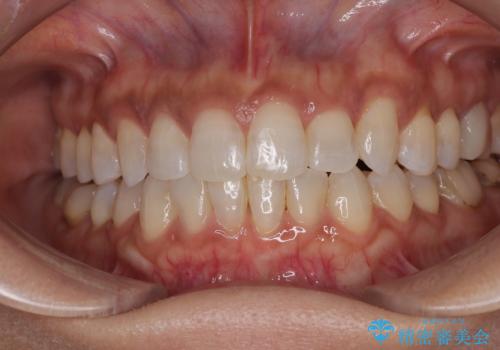 クロスバイトを治したい インビザラインによる矯正治療の症例 治療後