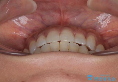 クロスバイトを治したい　インビザラインによる矯正治療の治療後