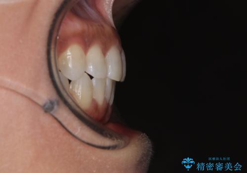 クロスバイトを治したい　インビザラインによる矯正治療の治療後